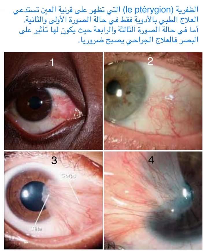 الظفرية